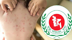 একদিনে হাম ও উপসর্গে আরও ৭ জনের মৃত্যু