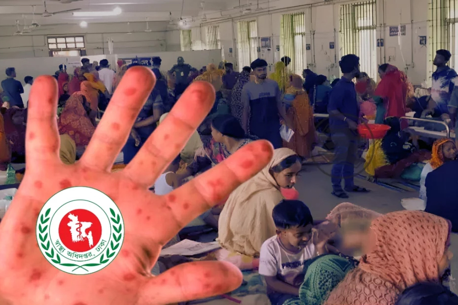 একদিনে হাম উপসর্গে পাঁচ জনের মৃত্যু
