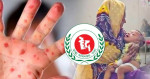 হাম ও উপসর্গে এখন পর্যন্ত ৭৮০ জনের মৃত্যু